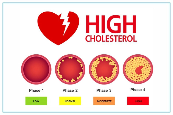 High Cholesterol Causes, Signs, And Effects On The Body